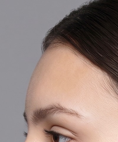 Forehead Botox — the area treated, in close-up