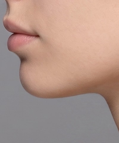 Masseter Botox — the area treated, in close-up