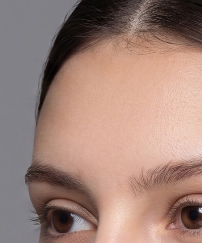 Forehead Filler — the area treated, in close-up