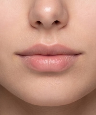Lip Filler — the area treated, in close-up