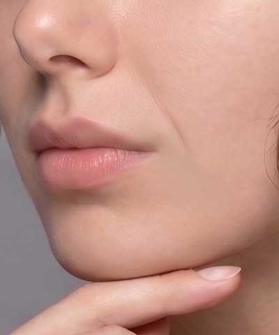 Smile Line Filler — the area treated, in close-up