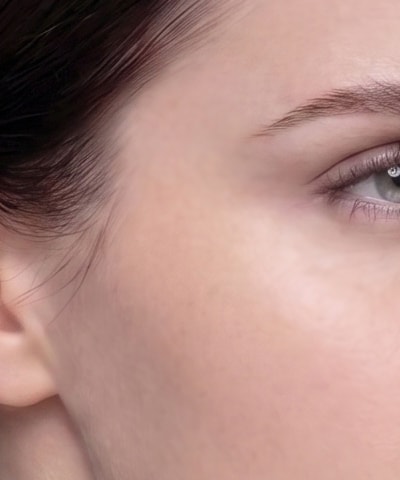 Temple Filler — the area treated, in close-up