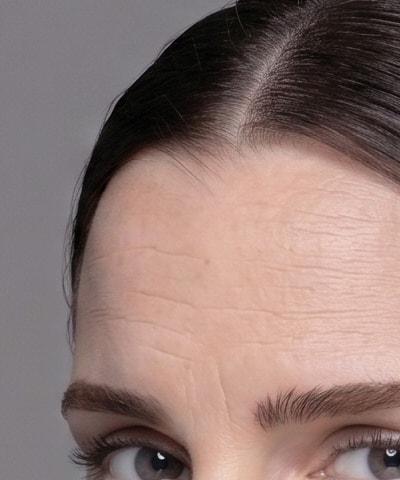 Wrinkle Filler — the area treated, in close-up