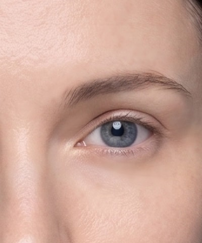 Upper Blepharoplasty — the area treated, in close-up