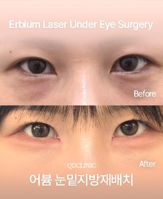 Before and after Erbium Laser Under Eye Surgery