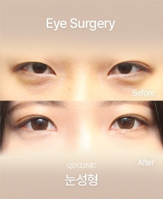 Before and after Eye Surgery