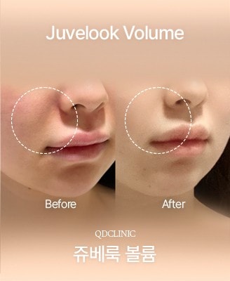 Before and after Juvelook Volume