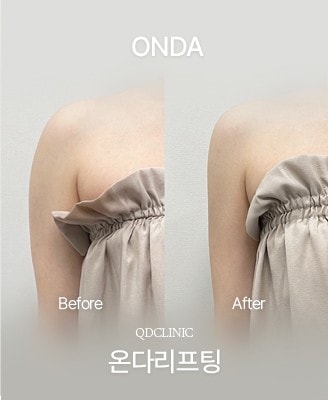 Before and after ONDA Lifting