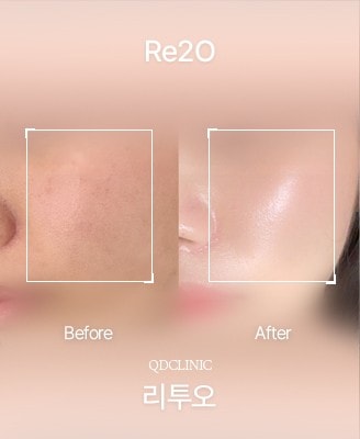 Before and after Re2O