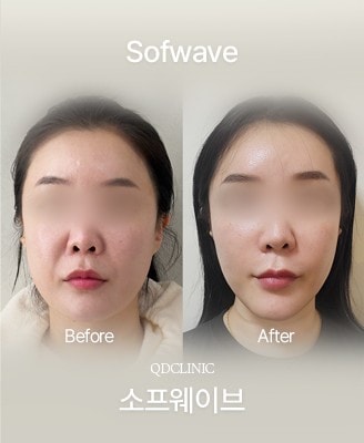 Before and after Sofwave
