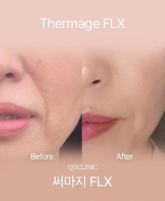 Before and after Thermage FLX
