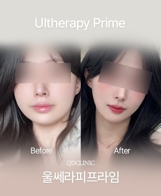 Before and after Ultherapy PRIME