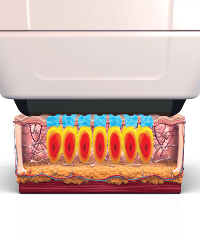 Sofwave لخط الفك — رسم توضيحي للعمق الذي تصل إليه الطاقة داخل البشرة